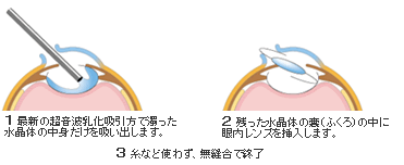 白内障の手術