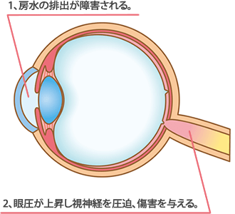 1.房水の排出が障害される。2.眼圧が上昇し神経を圧迫、障害を与える。